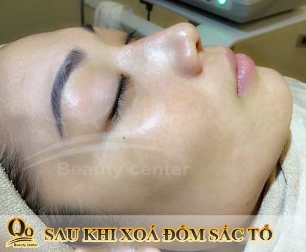 Hình ảnh điều trị nám da và tàn nhang 