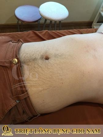 co nen tay long bung