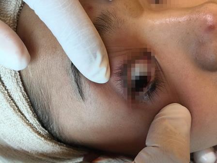 Xóa nốt ruồi ở mí mắt