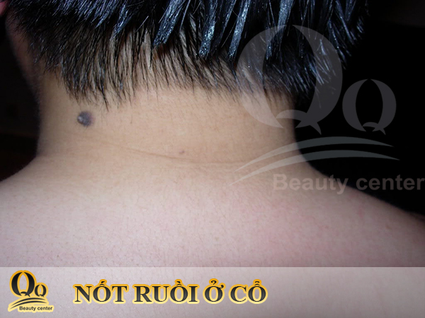 Tẩy nốt ruồi ở cổ đàn ông