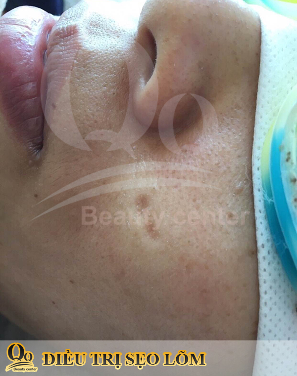 Thuốc trị sẹo thủy đậu hiệu quả nhất