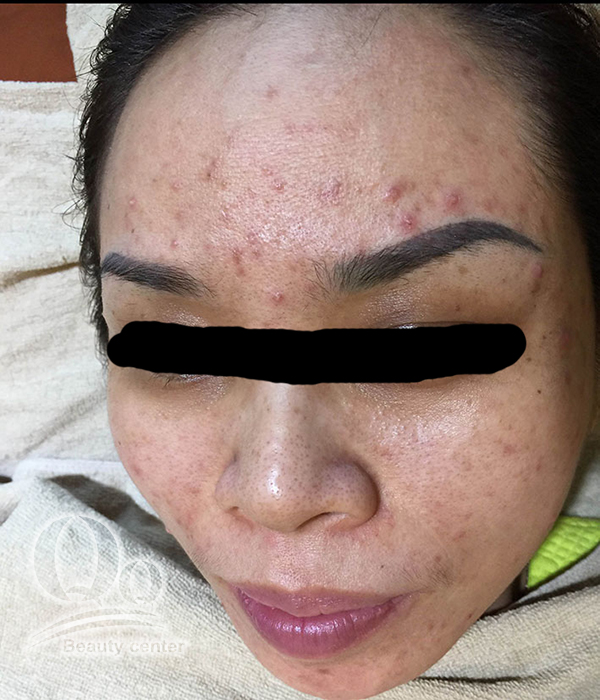 Giá lấy nhân mụn bao nhiêu tiền ? 