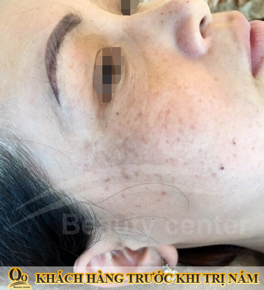 Lột da mặt bằng rượu rễ cây có tác hại gì ? 