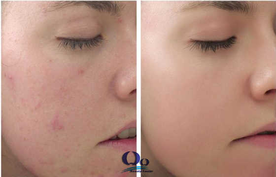 cach tri mun boc sieu hieu qua hinh anh 2