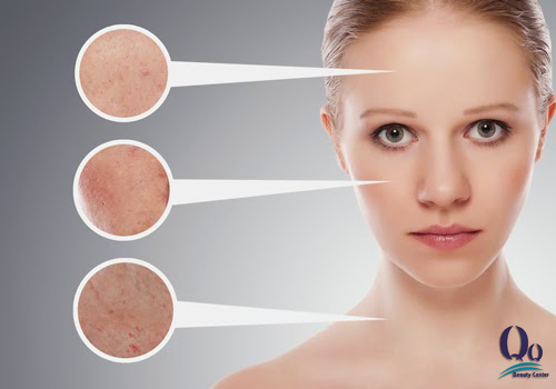 Cách trị mụn cám siêu tốc