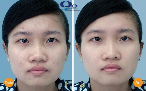 cach tri mun dau den hieu qua hinh anh 2