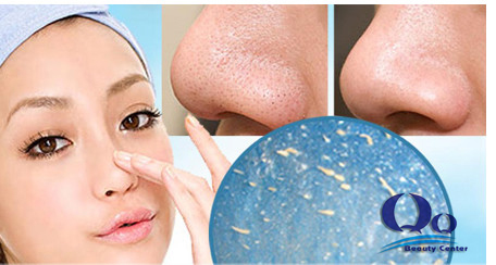 Cách điều trị mụn đầu đen hiệu quả nhất