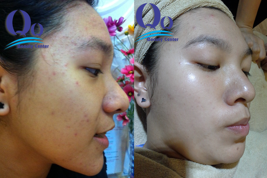 cach tri mun sieu toc hieu qua hinh anh 2