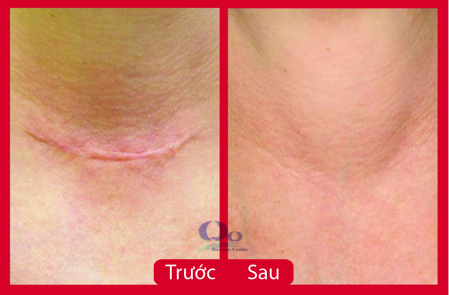 cach tri seo loi hieu qua hinh anh 2