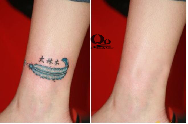 Cách xóa xăm ở cánh tay