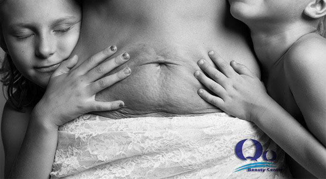 thoi bay vet ran d sau khi sinh hinh anh