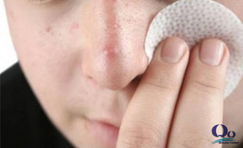 Trị mụn bọc dứt điểm