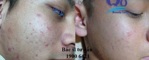 Phuc hoi da bi mun, seo mun